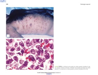 498 Patología especial
FIGURA 15-36. a) Linfoma de alto grado de células grandes hendidas B, pla-
cas, nódulos, hombre de 48 años. b) Detalle microscópico de linfoma de células
grandes B; se aprecian las células grandes y núcleos hendidos (HE x210).
(b)
(a)
© 2007 Editorial Médica Panamericana, S.A de C.V.
Cisfarm
 