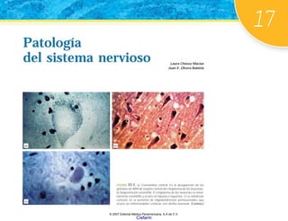 17
Laura Chávez Macías
Juan E. Olvera Rabiela
Patología
del sistema nervioso
Patología
del sistema nervioso
FIGURA 17-1. a) Cromatólisis central. Es la desaparición de los
gránulos de ARN de la parte central del citoplasma de las neuronas.
b) Degeneración eosinófila. El citoplasma de las neuronas es inten-
samente eosinófilo y ocurre en hipoxia e isquemia. c) La satelitosis
consiste en el aumento de oligodendrocitos perineuronales que
ocurre en enfermedades crónicas con atrofia neuronal. (Continúa.)
(a) (b)
(c)
© 2007 Editorial Médica Panamericana, S.A de C.V.
Cisfarm
 