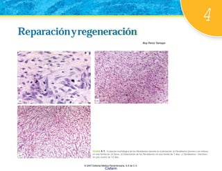 4
Reparaciónyregeneración
Reparaciónyregeneración
Ruy Pérez Tamayo
FIGURA 4-1. Evolución morfológica de los fibroblastos durante la cicatrización. a) Fibroblastos jóvenes con mitosis
en una herida de 24 horas. b) Polarización de los fibroblastos en una herida de 3 días. c) Fibroblastos “inactivos”
en una cicatriz de 10 días.
(b)
(c)
(a)
© 2007 Editorial Médica Panamericana, S.A de C.V.
Cisfarm
 