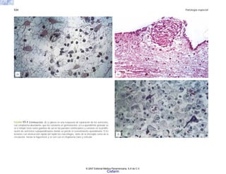 534 Patología especial
FIGURA 17-1 (Continuación). d) La gliosis es una respuesta de reparación de los astrocitos,
con citoplasma abundante, que los convierte en gemistocitos. e) La ependimitis granular se
ve a simple vista como granitos de sal en las paredes ventriculares y consiste en la prolife-
ración de astrocitos subependimarios donde se pierde el revestimiento ependimario. f) En
lesiones con destrucción rápida del tejido los macrófagos, tanto de la microglia como de la
circulación, inician la fagocitosis y se ven con el citoplasma claro y reticular.
(d)
(f)
(e)
© 2007 Editorial Médica Panamericana, S.A de C.V.
Cisfarm
 
