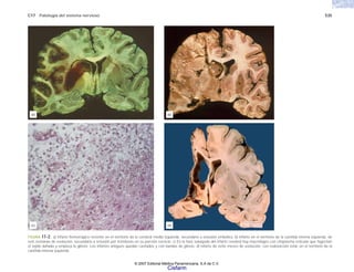 C17 Patología del sistema nervioso 535
FIGURA 17-2. a) Infarto hemorrágico reciente en el territorio de la cerebral media izquierda, secundario a oclusión embólica. b) Infarto en el territorio de la carótida interna izquierda, de
seis semanas de evolución, secundario a oclusión por trombosis en su porción cervical. c) En la fase subaguda del infarto cerebral hay macrófagos con citoplasma reticular que fagocitan
el tejido dañado y empieza la gliosis. Los infartos antiguos quedan cavitados y con bandas de gliosis. d) Infarto de ocho meses de evolución, con reabsorción total, en el territorio de la
carótida interna izquierda.
(a)
(c)
(b)
(d)
© 2007 Editorial Médica Panamericana, S.A de C.V.
Cisfarm
 