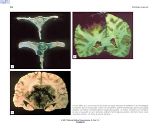536 Patología especial
FIGURA 17-3. a) El vaso venoso en que ocurre con mayor frecuencia la trombosis es el seno longitudi-
nal superior, que se muestra aquí cortado transversalmente. b) Infarto hemorrágico parietal, parasagital
izquierdo, secundario a trombosis del seno longitudinal superior. Los infartos secundarios a la trombosis
de este seno pueden ser uni o bilaterales. c) Infarto hemorrágico secundario a trombosis de las venas
cerebrales internas, con forma de alas de mariposa.
(a)
(b)
(c)
© 2007 Editorial Médica Panamericana, S.A de C.V.
Cisfarm
 
