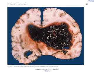 C17 Patología del sistema nervioso 537
FIGURA 17-4. Hemorragia asociada a hipertensión arterial en hemisferio cerebral derecho con extensión ventricular.
© 2007 Editorial Médica Panamericana, S.A de C.V.
Cisfarm
 