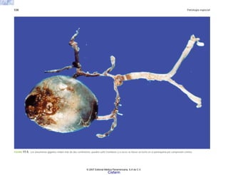 538 Patología especial
FIGURA 17-5. Los aneurismas gigantes miden más de dos centímetros, pueden sufrir trombosis y a veces se hacen un lecho en el parénquima por compresión crónica.
© 2007 Editorial Médica Panamericana, S.A de C.V.
Cisfarm
 