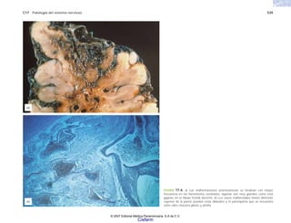 C17 Patología del sistema nervioso 539
FIGURA 17-6. a) Las malformaciones arteriovenosas se localizan con mayor
frecuencia en los hemisferios cerebrales, algunas son muy grandes como esta
gigante en el lóbulo frontal derecho. b) Los vasos malformados tienen diferente
espesor de la pared, pueden estar dilatados y el parénquima que se encuentra
entre ellos muestra gliosis y atrofia.
(a)
(b)
© 2007 Editorial Médica Panamericana, S.A de C.V.
Cisfarm
 