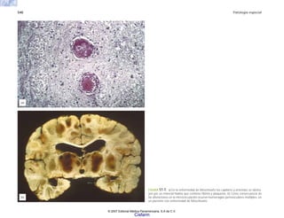 540 Patología especial
FIGURA 17-7. a) En la enfermedad de Moschowitz los capilares y arteriolas se obstru-
yen por un material hialino que contiene fibrina y plaquetas. b) Como consecuencia de
las alteraciones en la microcirculación ocurren hemorragias perivasculares múltiples, en
un paciente con enfermedad de Moschowitz.
(a)
(b)
© 2007 Editorial Médica Panamericana, S.A de C.V.
Cisfarm
 
