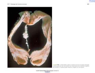 C17 Patología del sistema nervioso 541
FIGURA 17-8. La hidrocefalia se debe a la obstrucción de la circulación del líquido
cerebroespinal; en este caso extremo fue consecuencia de la estenosis congénita
del acueducto. El septum puede romperse o rasgarse en casos graves.
© 2007 Editorial Médica Panamericana, S.A de C.V.
Cisfarm
 