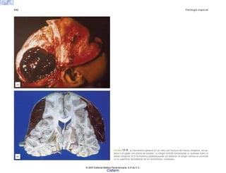 542 Patología especial
FIGURA 17-9. a) Hematoma epidural en un niño con fractura del hueso temporal, secun-
daria a un golpe con pelota de beisbol. La sangre arterial extravasada se acumula sobre el
lóbulo temporal. b) El hematoma subdural puede ser bilateral; la sangre venosa se acumula
en la superficie dorsolateral de los hemisferios cerebrales.
(a)
(b)
© 2007 Editorial Médica Panamericana, S.A de C.V.
Cisfarm
 