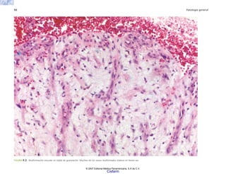 50 Patología general
FIGURA 4-2. Neoformación vascular en tejido de granulación. Muchos de los vasos neoformados todavía no tienen luz.
© 2007 Editorial Médica Panamericana, S.A de C.V.
Cisfarm
 