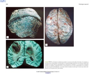 544 Patología especial
FIGURA 17-11. a) Empiema subdural secundario a escaras de decúbito infectadas. El exudado se
acumula entre la duramadre y la aracnoides. b) Leptomeningitis purulenta con acúmulo máximo del
exudado en la parte dorsal y parasagital de los hemisferios cerebrales. c) Los abscesos cerebrales
pueden ser múltiples y dependen para su encapsulación de los vasos neoformados en la periferia,
que son la fuente de fibroblastos, y se notan como un anillo de color rojo. En este caso como com-
plicación de bronquiectasias abscedadas.
(a)
(b)
(c)
© 2007 Editorial Médica Panamericana, S.A de C.V.
Cisfarm
 
