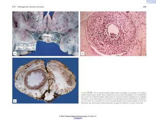 C17 Patología del sistema nervioso 545
FIGURA 17-12. a) En la leptomeningitis tuberculosa el exudado se acumula en el espacio
subaracnoideo basal, donde rodea al quiasma y a las arterias del polígono. b) La endarteritis
que ocurre en la leptomeningitis tuberculosa es causa de lesiones isquémicas en múltiples
territorios. c) Los tuberculomas se localizan en el parénquima de los hemisferios cerebrales,
y en los niños en el cerebelo. En este caso pudo alcanzar gran tamaño porque se hizo una
derivación que disminuyó la hidrocefalia que causaba al comprimir el cuarto ventrículo.
(a) (b)
(c)
© 2007 Editorial Médica Panamericana, S.A de C.V.
Cisfarm
 
