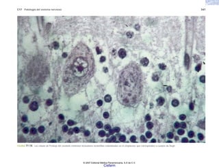 C17 Patología del sistema nervioso 547
FIGURA 17-14. Las células de Purkinje del cerebelo contienen inclusiones eosinófilas redondeadas en el citoplasma, que corresponden a cuerpos de Negri.
© 2007 Editorial Médica Panamericana, S.A de C.V.
Cisfarm
 