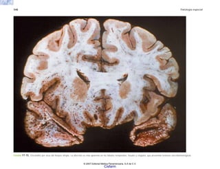 548 Patología especial
FIGURA 17-15. Encefalitis por virus del herpes simple. La afección es más aparente en los lóbulos temporales, ínsulas y cíngulos, que presentan lesiones necrohemorrágicas.
© 2007 Editorial Médica Panamericana, S.A de C.V.
Cisfarm
 