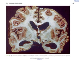 C17 Patología del sistema nervioso 549
FIGURA 17-16. Panencefalitis esclerosante subaguda con afección de todos los lóbulos e hidrocefalia ex vacuo. La consistencia del encéfalo en estos casos está aumentada.
© 2007 Editorial Médica Panamericana, S.A de C.V.
Cisfarm
 