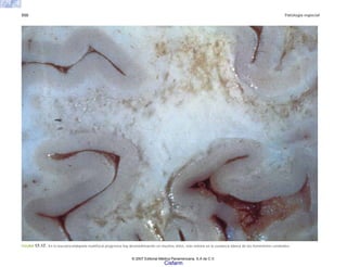 550 Patología especial
FIGURA 17-17. En la leucoencefalopatía multifocal progresiva hay desmielinización en muchos sitios, más notoria en la sustancia blanca de los hemisferios cerebrales.
© 2007 Editorial Médica Panamericana, S.A de C.V.
Cisfarm
 