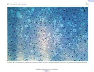 C17 Patología del sistema nervioso 551
FIGURA 17-18. En la enfermedad de Creutzfeldt-Jakob la corteza tiene aspecto microquístico con pérdida neuronal, por lo que se le ha dado el nombre de encefalopatía espongiforme.
© 2007 Editorial Médica Panamericana, S.A de C.V.
Cisfarm
 