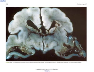 552 Patología especial
FIGURA 17-19. La toxoplasmosis congénita cursa con destrucción extensa del encéfalo, en especial en la corteza y vecindad de los ventrículos, con calcificaciones múltiples.
© 2007 Editorial Médica Panamericana, S.A de C.V.
Cisfarm
 