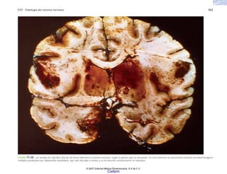 C17 Patología del sistema nervioso 553
FIGURA 17-20. Las amibas de vida libre afectan de forma diferente al sistema nervioso, según el género que se encuentre. En este enfermo se encontraron lesiones necrohemorrágicas
múltiples producidas por Balamuthia mandrillaris, que sólo afectaba a monos y se ha descrito recientemente en humanos.
© 2007 Editorial Médica Panamericana, S.A de C.V.
Cisfarm
 