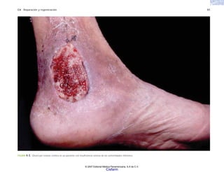 C4 Reparación y regeneración 51
FIGURA 4-3. Úlcera por estasis crónica en un paciente con insuficiencia venosa de las extremidades inferiores.
© 2007 Editorial Médica Panamericana, S.A de C.V.
Cisfarm
 