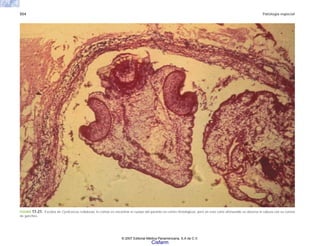 554 Patología especial
FIGURA 17-21. Escólex de Cysticercus cellulosae; lo común es encontrar el cuerpo del parásito en cortes histológicos, pero en este corte afortunado se observa la cabeza con su corona
de ganchos.
© 2007 Editorial Médica Panamericana, S.A de C.V.
Cisfarm
 