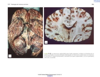 C17 Patología del sistema nervioso 555
FIGURA 17-22. a) Cisticercosis subaracnoidea basal. Puede evolucionar a la fibrosis con formación de un
plastrón que impide la circulación del líquido cefalorraquídeo. b) Cisticercosis cerebral masiva. Los cisticercos
se encuentran en espacios perivasculares, extensiones del espacio subaracnoideo, y no en el parénquima
como antes se pensaba.
(a)
(b)
© 2007 Editorial Médica Panamericana, S.A de C.V.
Cisfarm
 