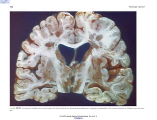 556 Patología especial
FIGURA 17-23. La esclerosis múltiple en su forma crónica (de Charcot) cursa con placas de desmielinización, irregulares y deprimidas, en la sustancia blanca de múltiples sitios del encé-
falo.
© 2007 Editorial Médica Panamericana, S.A de C.V.
Cisfarm
 