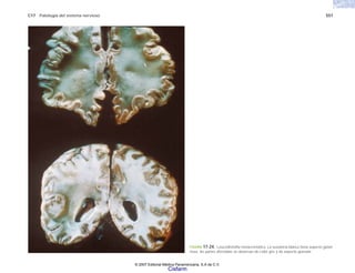 C17 Patología del sistema nervioso 557
FIGURA 17-24. Leucodistrofia metacromática. La sustancia blanca tiene aspecto gelati-
noso, las partes afectadas se observan de color gris y de aspecto granular.
© 2007 Editorial Médica Panamericana, S.A de C.V.
Cisfarm
 