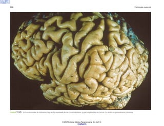 558 Patología especial
FIGURA 17-25. En la enfermedad de Alzheimer hay atrofia acentuada de las circunvoluciones y gran amplitud de los surcos. La atrofia es generalmente simétrica.
© 2007 Editorial Médica Panamericana, S.A de C.V.
Cisfarm
 