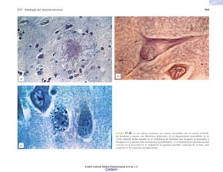 C17 Patología del sistema nervioso 559
FIGURA 17-26. a) Las placas neuríticas son masas eosinófilas con un centro amiloide,
de dendritas y axones con filamentos anormales. b) La degeneración neurofibrilar se ve
como material fibrilar basófilo en el citoplasma de neuronas que después se destruyen y
desaparecen, y quedan sólo las marañas neurofibrilares. c) La degeneración granulovacuolar
consiste en la presencia en el citoplasma de gránulos basófilos rodeados de un halo, más
evidente en las neuronas del hipocampo.
(a)
(b)
(c)
© 2007 Editorial Médica Panamericana, S.A de C.V.
Cisfarm
 