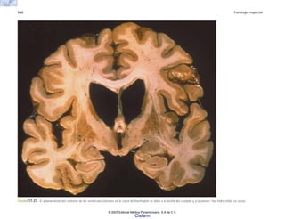 560 Patología especial
FIGURA 17-27. El aplanamiento del contorno de los ventrículos laterales en la corea de Huntington se debe a la atrofia del caudado y el putamen. Hay hidrocefalia ex vacuo.
© 2007 Editorial Médica Panamericana, S.A de C.V.
Cisfarm
 