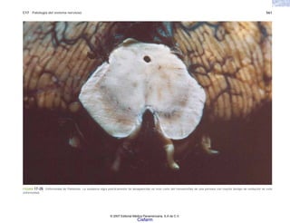 C17 Patología del sistema nervioso 561
FIGURA 17-28. Enfermedad de Parkinson. La sustancia nigra prácticamente ha desaparecido en este corte del mesencéfalo de una persona con mucho tiempo de evolución de esta
enfermedad.
© 2007 Editorial Médica Panamericana, S.A de C.V.
Cisfarm
 