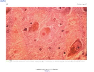 562 Patología especial
FIGURA 17-29. Los cuerpos de Lewy en las neuronas residuales de la sustancia nigra y el locus coeruleus son característicos, aunque no exclusivos de la enfermedad de Parkinson.
© 2007 Editorial Médica Panamericana, S.A de C.V.
Cisfarm
 