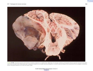 C17 Patología del sistema nervioso 563
FIGURA 17-30. Astrocitoma quístico del hemisferio cerebeloso izquierdo en un adolescente. Había datos de asinergia cerebelosa y lateropulsión hacia la izquierda. Posteriormente apare-
cieron datos de hipertensión endocraneana que se agravaron después de un estudio neumoencefalográfico. La muerte sobrevino después del enclavamiento de las amigdalas cerebelosas.
Nótese una porción quística en el centro de la parte sólida.
© 2007 Editorial Médica Panamericana, S.A de C.V.
Cisfarm
 