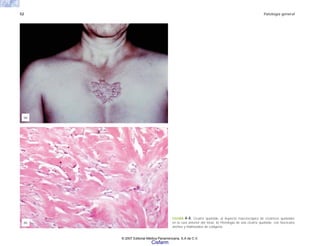 52 Patología general
FIGURA 4-4. Cicatriz queloide. a) Aspecto macroscópico de cicatrices queloides
en la cara anterior del tórax. b) Histología de una cicatriz queloide, con fascículos
anchos y hialinizados de colágena.
(b)
(a)
© 2007 Editorial Médica Panamericana, S.A de C.V.
Cisfarm
 