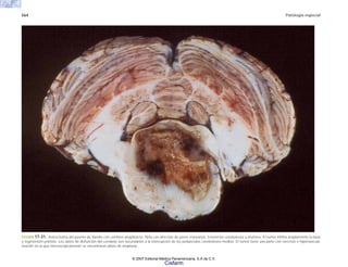 564 Patología especial
FIGURA 17-31. Astrocitoma del puente de Varolio con cambios anaplásicos. Niña con afección de pares craneanos, trastornos cerebelosos y motores. El tumor infiltra ampliamente la base
y tegmentum pontino. Los datos de disfunción del cerebelo son secundarios a la interrupción de los pedúnculos cerebelosos medios. El tumor tiene una parte con necrosis e hipervascula-
rización en la que microscópicamente se encontraron datos de anaplasia.
© 2007 Editorial Médica Panamericana, S.A de C.V.
Cisfarm
 