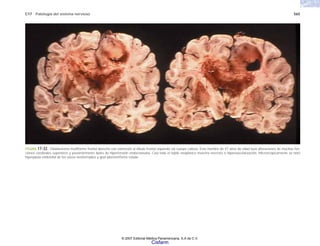 C17 Patología del sistema nervioso 565
FIGURA 17-32. Glioblastoma multiforme frontal derecho con extensión al lóbulo frontal izquierdo vía cuerpo calloso. Este hombre de 47 años de edad tuvo alteraciones de muchas fun-
ciones cerebrales superiores y posteriormente datos de hipertensión endocraneana. Casi todo el tejido neoplásico muestra necrosis e hipervascularización. Microscópicamente se notó
hiperplasia endotelial de los vasos neoformados y gran pleomorfismo celular.
© 2007 Editorial Médica Panamericana, S.A de C.V.
Cisfarm
 