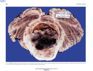 566 Patología especial
FIGURA 17-33. Ependimoma del cuarto ventrículo en un hombre de 34 años de edad. Los datos clínicos principales fueron trastornos cerebelosos e hipertensión endocraneana. El tumor
es de gran tamaño y ha bloqueado casi totalmente la circulación del líquido cefalorraquídeo.
© 2007 Editorial Médica Panamericana, S.A de C.V.
Cisfarm
 
