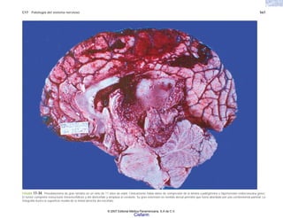 C17 Patología del sistema nervioso 567
FIGURA 17-34. Pineoblastoma de gran tamaño en un niño de 11 años de edad. Clínicamente había datos de compresión de la lámina cuadrigémina e hipertensión endocraneana grave.
El tumor comprime estructuras mesencefálicas y del diencéfalo y desplaza al cerebelo. Su gran extensión en sentido dorsal permitió que fuera abordado por una cerebrotomía parietal. La
fotografía ilustra la superficie medial de la mitad derecha del encéfalo.
© 2007 Editorial Médica Panamericana, S.A de C.V.
Cisfarm
 