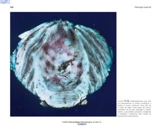 568 Patología especial
FIGURA 17-35. Meduloblastoma que infil-
tra extensamente al vermis cerebeloso e
invade el cuarto ventriculo. Este niño de
13 años de edad tenía ataxia del tronco,
caminaba con los pies separados y tamba-
leantes y presentaba sensación vertiginosa
y nistagmus. Finalmente tuvo cuadro de
hipertensión endocraneana.
© 2007 Editorial Médica Panamericana, S.A de C.V.
Cisfarm
 