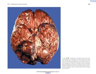 C17 Patología del sistema nervioso 569
FIGURA 17-36. Schwannoma o neurilemoma del nervio acús-
tico derecho. Fue un hombre de 55 años de edad con varios
años de hipoacusia, que progresó a la anacusia, afección de
varios nervios craneanos bajos, trastornos cerebelosos y hemi-
paresia izquierda. Se intentó su resección y sólo se obtuvieron
algunos fragmentos de cerebelo. El enfermo murió en el poso-
peratorio inmediato. Nótese el gran tamaño del tumor que se
encuentra alojado en lo que los neurocirujanos llaman el ángulo
pontocerebeloso.
© 2007 Editorial Médica Panamericana, S.A de C.V.
Cisfarm
 