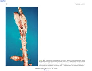 570 Patología especial
FIGURA 17-37. Schwannomas intraespinares en una mujer de 36 años de edad con enfermedad de Von
Recklinghausen. El mayor comprime varios segmentos cervicales de la médula espinal. Hay otro de menor
tamaño en el segmento torácico con la huella del agujero de conjunción por el que creció fuera del conducto
espinal, lo que le dio el aspecto descrito como en reloj de arena. Se intentó su resección mediante un aborda-
je inadecuado, hubo edema grave de la médula espinal y la paciente falleció con insuficiencia ventilatoria.
© 2007 Editorial Médica Panamericana, S.A de C.V.
Cisfarm
 
