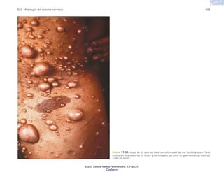 C17 Patología del sistema nervioso 571
FIGURA 17-38. Mujer de 42 años de edad con enfermedad de Von Recklinghausen. Tenía
incontables neurofibromas en tronco y extremidades, así como un gran número de manchas
“café con leche”.
© 2007 Editorial Médica Panamericana, S.A de C.V.
Cisfarm
 