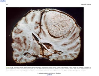 572 Patología especial
FIGURA 17-39. Meningioma de gran tamaño sobre la superficie dorsolateral del hemisferio cerebral derecho. Ocurrió en un hombre de 42 años de edad que tenía más de tres años con
trastornos motores y sensitivos en el hemicuerpo izquierdo. Su cuadro de hipertensión endocraneana era de más de un año de duración y ya tenía atrofia bilateral de la papila óptica. Los
huesos de la bóveda estaban invadidos por el tumor. Durante la craneotomía para su resección hubo sangrado masivo en los agujeros de trépano que no pudo ser controlado.
© 2007 Editorial Médica Panamericana, S.A de C.V.
Cisfarm
 