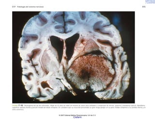 C17 Patología del sistema nervioso 573
FIGURA 17-40. Meningioma del ala del esfenoides. Mujer de 45 años de edad con historia de varios años atribuible a compresión de nervios, quiasma y bandaletas ópticas, hipotálamo,
superficie orbitaria frontal y porción medial del lóbulo temporal. Se consideró que su resección presentaba un gran riesgo porque en su parte medial comprimía a la carótida interna y al
seno cavernoso.
© 2007 Editorial Médica Panamericana, S.A de C.V.
Cisfarm
 