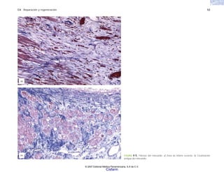 C4 Reparación y regeneración 53
(a)
(b) FIGURA 4-5. Fibrosis del miocardio. a) Zona de infarto reciente. b) Cicatrización
antigua del miocardio.
© 2007 Editorial Médica Panamericana, S.A de C.V.
Cisfarm
 