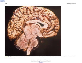 574 Patología especial
FIGURA 17-41. Tumor germinal de gran tamaño, sobre la superficie dorsal del mesencéfalo, en un joven de 15 años de edad. Su aspecto microscópico es idéntico al seminoma del tes-
tículo, sin otros componentes.
© 2007 Editorial Médica Panamericana, S.A de C.V.
Cisfarm
 
