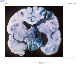 576 Patología especial
FIGURA 17-43. Craniofaringioma en un nino de 11 años de edad con retraso en el crecimiento, ceguera y datos de hipertensión endocraneana. Nótese su gran tamaño y aspecto multi-
quístico. Fue biopsiado mediante craneotomía frontal.
© 2007 Editorial Médica Panamericana, S.A de C.V.
Cisfarm
 