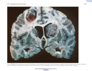 C17 Patología del sistema nervioso 577
FIGURA 17-44. Metástasis múltiples de carcinoma broncogénico de células pequeñas. Había otras en ambos hemisferios cerebrales y cerebelosos además de las dos que se ilustran en
esta foto, localizadas en el lóbulo frontal izquierdo y núcleo caudado derecho. Se trató de un hombre de 56 años de edad con tabaquismo intenso desde su juventud.
© 2007 Editorial Médica Panamericana, S.A de C.V.
Cisfarm
 