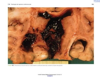 C18 Patología del aparato cardiovascular 583
FIGURA 18-3. Aneurisma en fresa de base de cráneo abierto al ventrículo lateral que ocasionó la muerte del paciente.
© 2007 Editorial Médica Panamericana, S.A de C.V.
Cisfarm
 