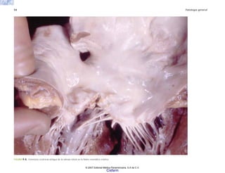 54 Patología general
FIGURA 4-6. Estenosis cicatricial antigua de la válvula mitral en la fiebre reumática crónica.
© 2007 Editorial Médica Panamericana, S.A de C.V.
Cisfarm
 